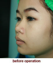 plastic_surgery_augmentation_rhinoplasty